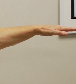 Liposuction before and after - after