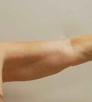 Liposuction before and after - before