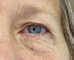 Blepharoplasty before and after - after