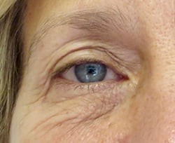 Blepharoplasty before and after - before