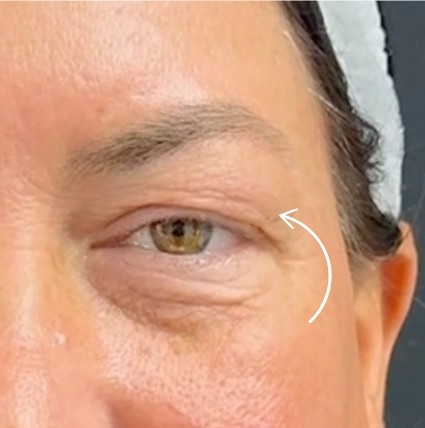 Blepharoplasty before and after - after