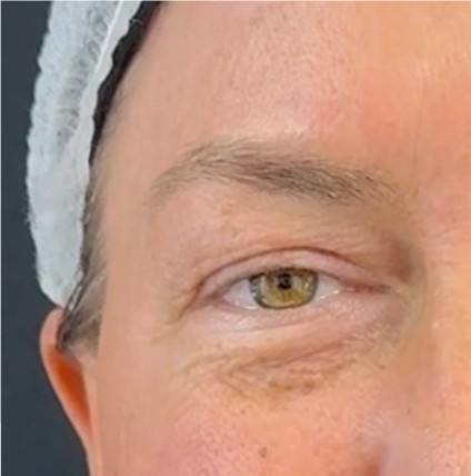 Blepharoplasty before and after - before