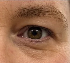 Blepharoplasty before and after - after