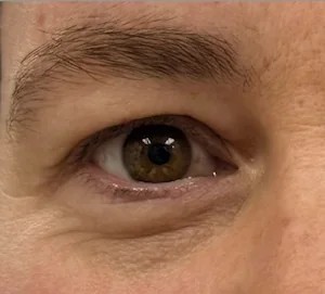 Blepharoplasty before and after - before