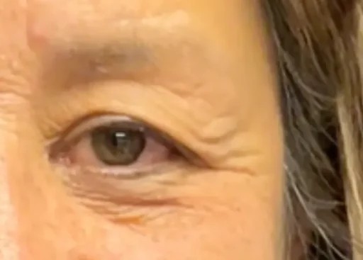 Blepharoplasty before and after - after