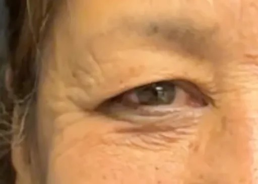 Blepharoplasty before and after - before