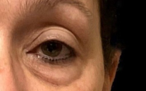 Blepharoplasty before and after - after