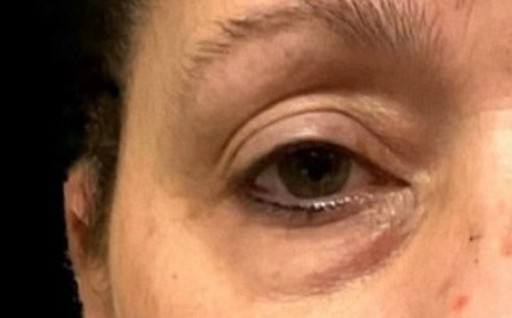 Blepharoplasty before and after - before