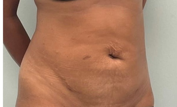 Liposuction before and after - after