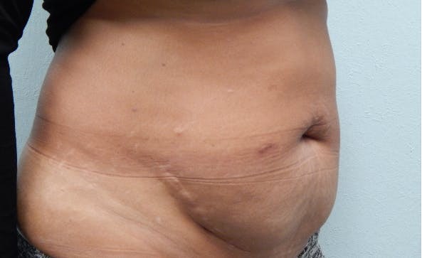 Liposuction before and after - before