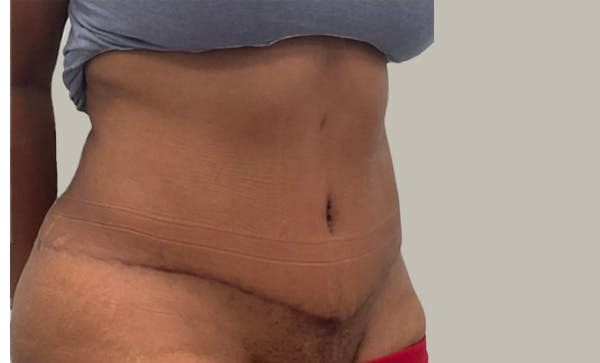 Liposuction before and after - after