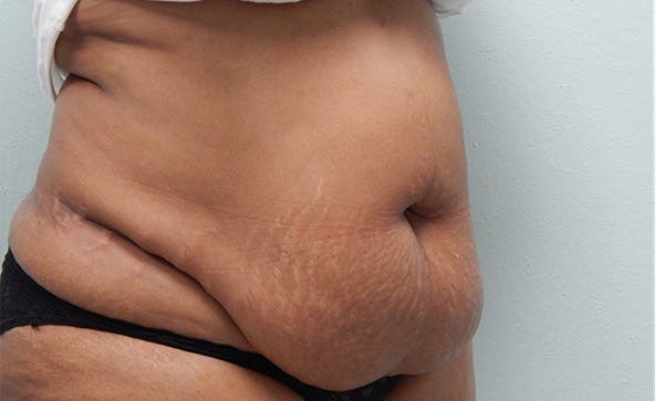 Liposuction before and after - before