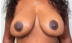 Breast Augmentation before and after - after