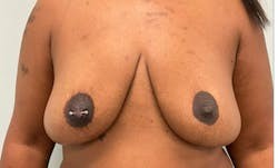 Breast Augmentation before and after - before