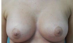 Breast Augmentation before and after - after