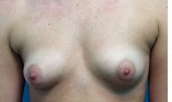 Breast Augmentation before and after - before