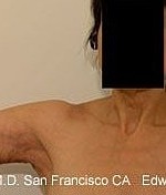 Arm Lift after — Dr. Edward Miranda