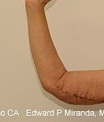 Arm Lift before — Dr. Edward Miranda