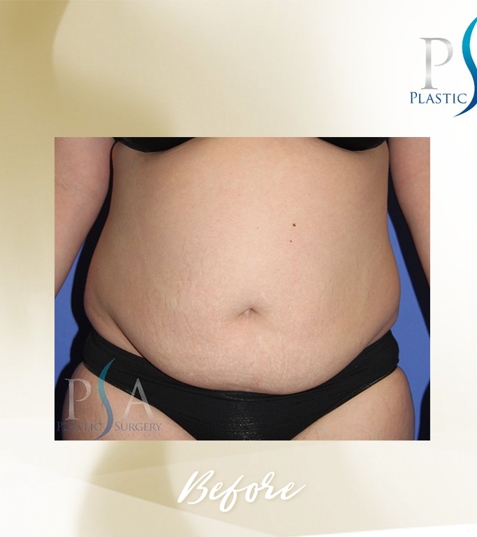 Abdominoplasty before and after - before