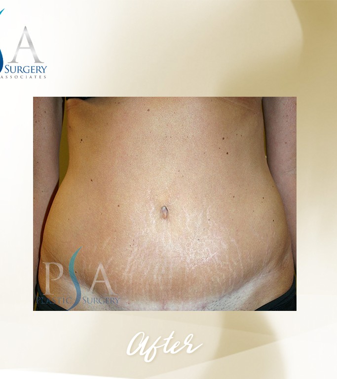 Abdominoplasty before and after - after