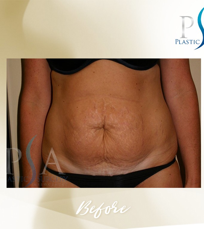 Abdominoplasty before and after - before