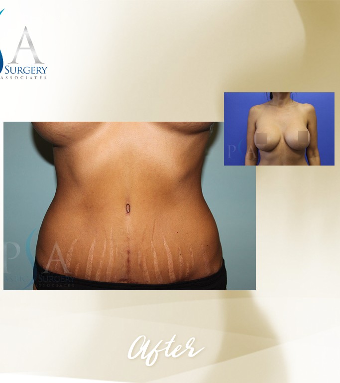 Mommy Makeover after — Dr. Daniel Kim