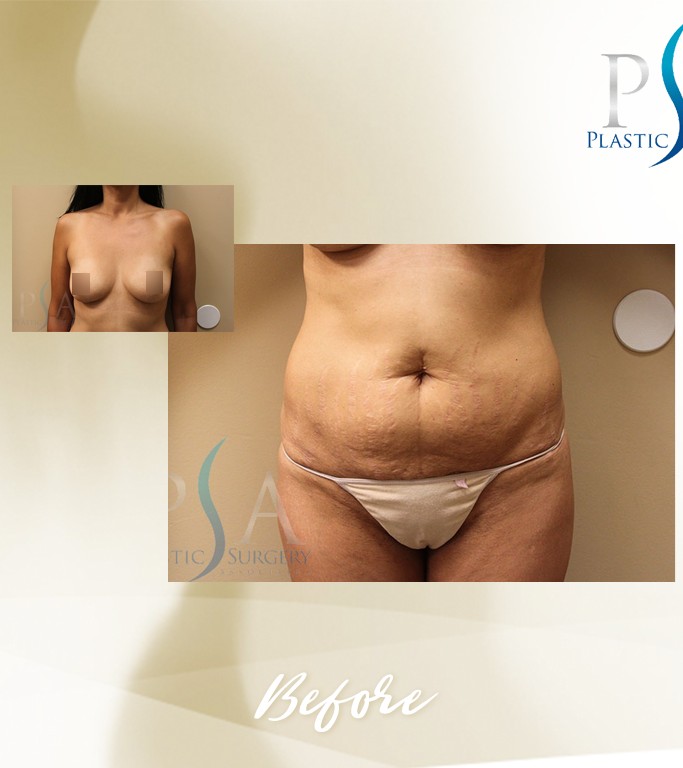 Mommy Makeover before — Dr. Daniel Kim