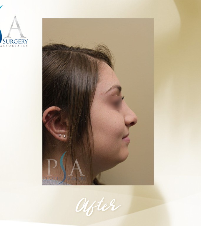 Rhinoplasty before and after - after
