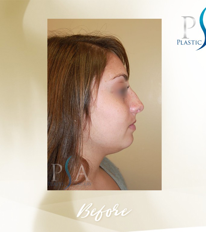 Rhinoplasty before and after - before