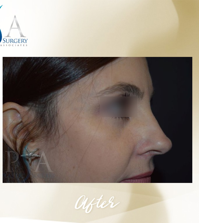 Blepharoplasty before and after - after