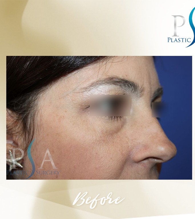 Blepharoplasty before and after - before