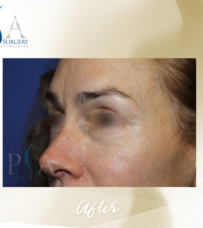 Blepharoplasty before and after - after