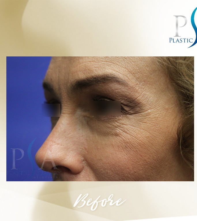 Blepharoplasty before and after - before