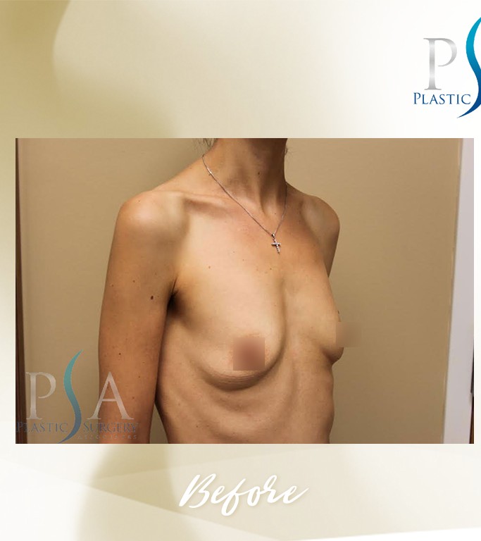 Breast Augmentation before and after - before