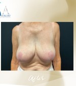 Breast Implant Removal with Breast Reduction before and after - after