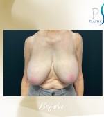 Breast Implant Removal with Breast Reduction before and after - before