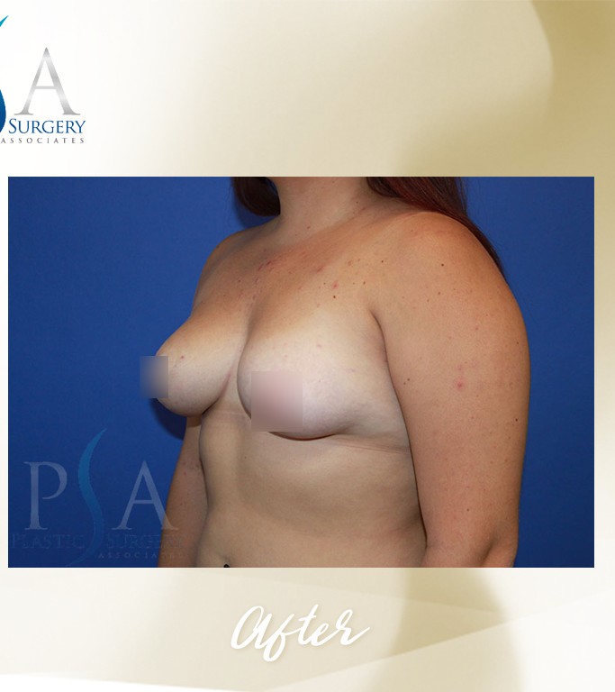 Breast Reduction before and after - after