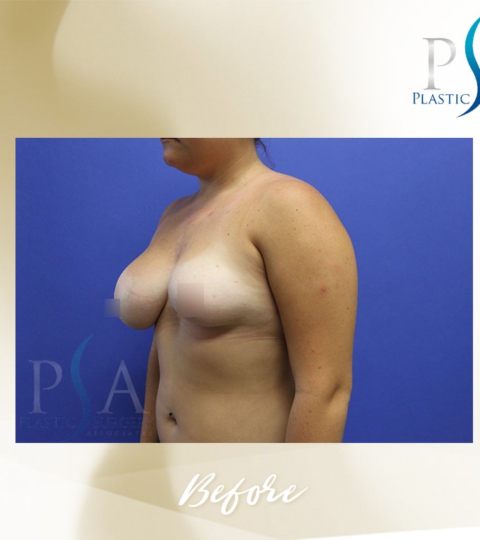 Breast Reduction before and after - before