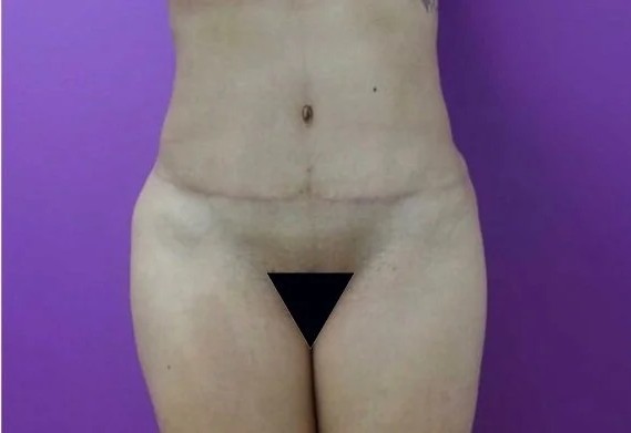 Tummy Tuck after — Dr. Nachman Rosenfeld