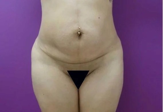Tummy Tuck before — Dr. Nachman Rosenfeld