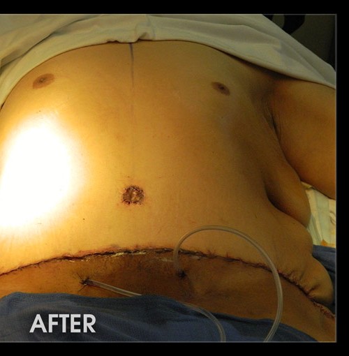 Liposuction and Tummy Tuck before and after - after