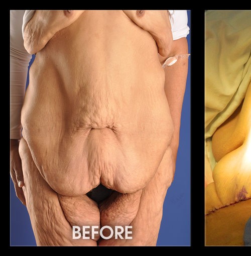 Liposuction and Tummy Tuck before and after - before