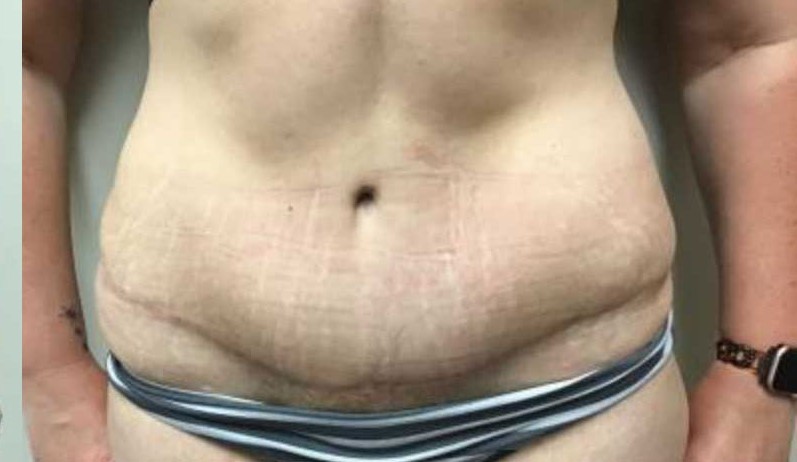 Abdominoplasty before and after - after
