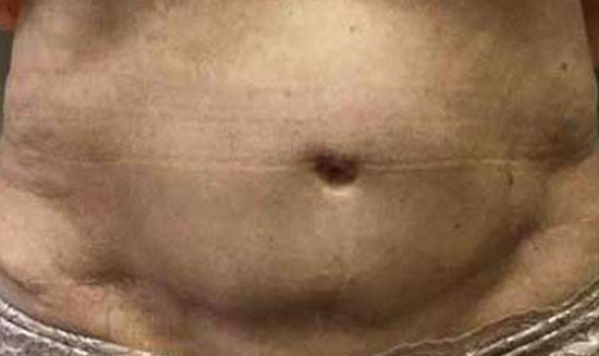 Abdominoplasty before and after - after