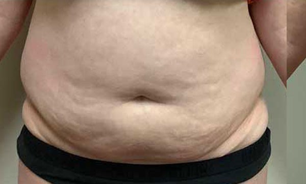 Abdominoplasty before and after - before