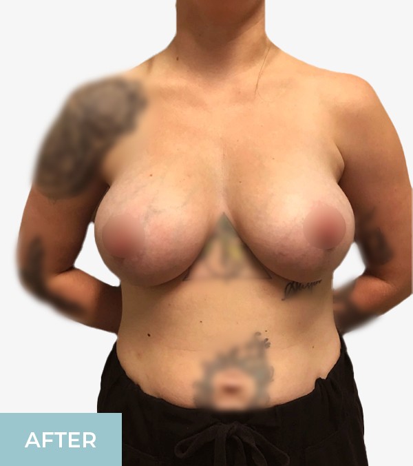 Breast Augmentation before and after - after