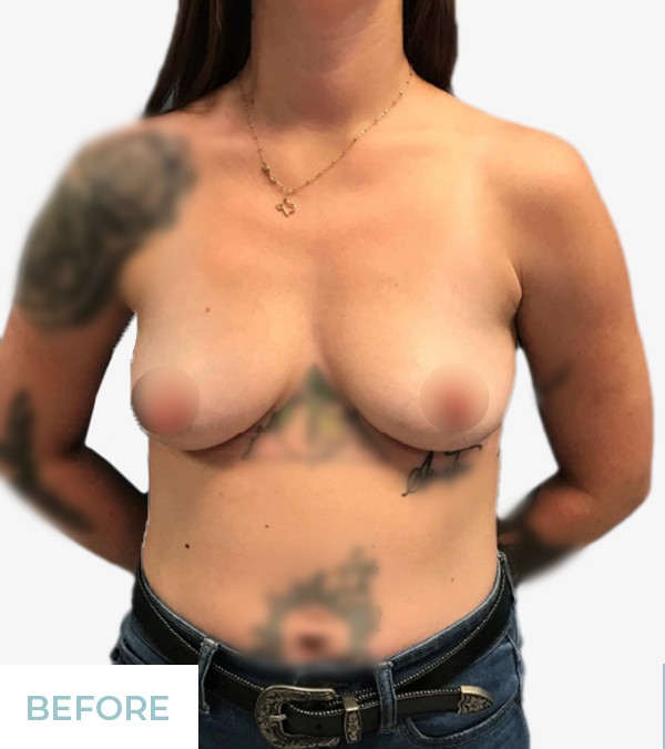Breast Augmentation before and after - before