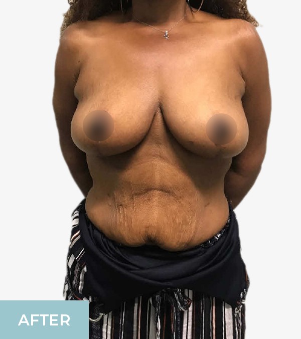 Breast Lift (Mastopexy) before and after - after