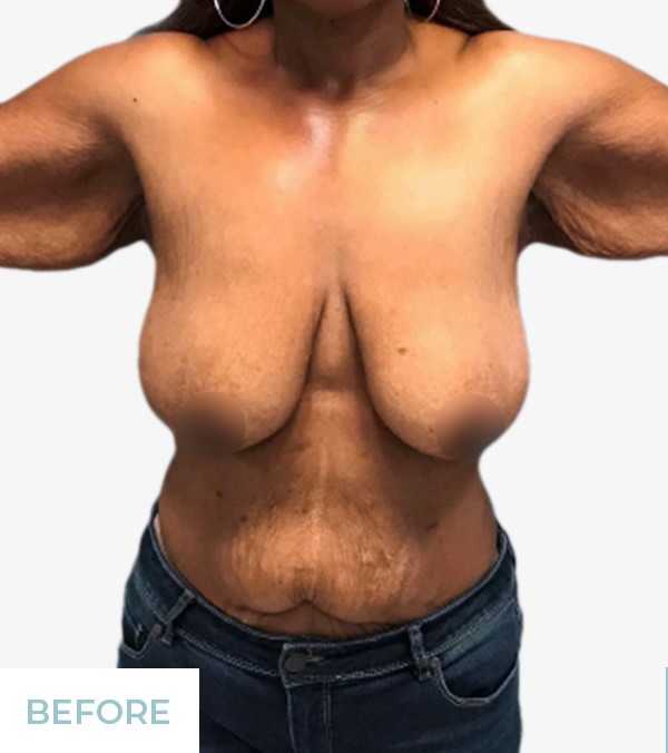 Breast Lift (Mastopexy) before and after - before