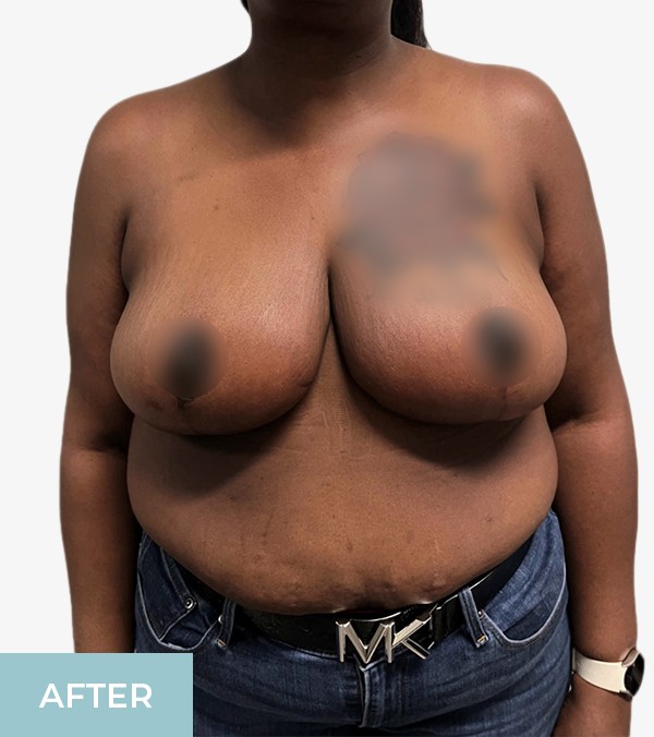 Breast Reduction before and after - after